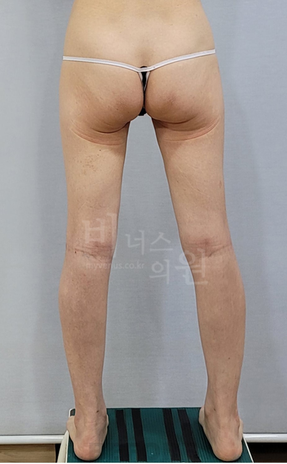 엉덩이축소 지방흡입 수술 전 후면 사진