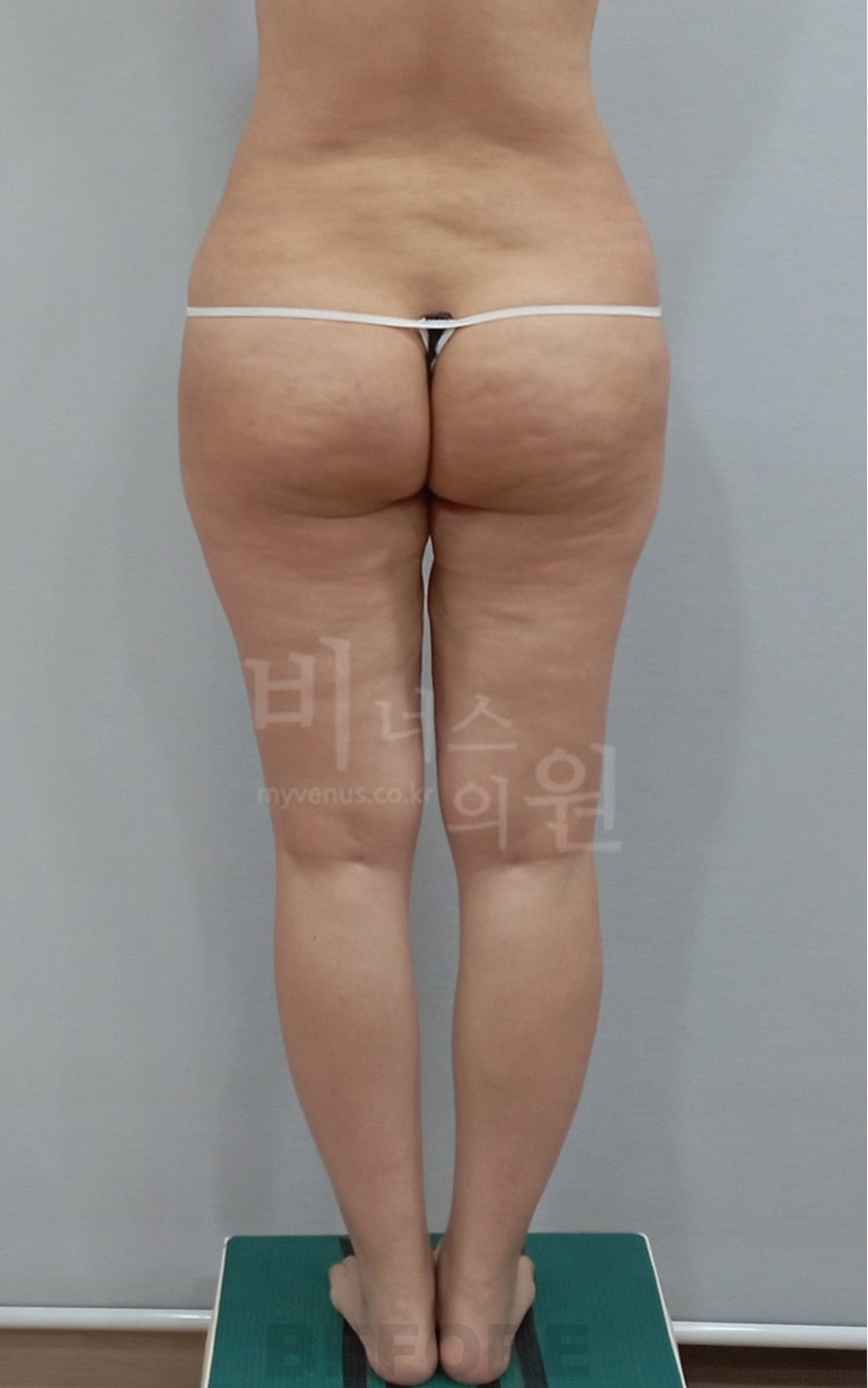 엉덩이축소 지방흡입 수술 전 후면