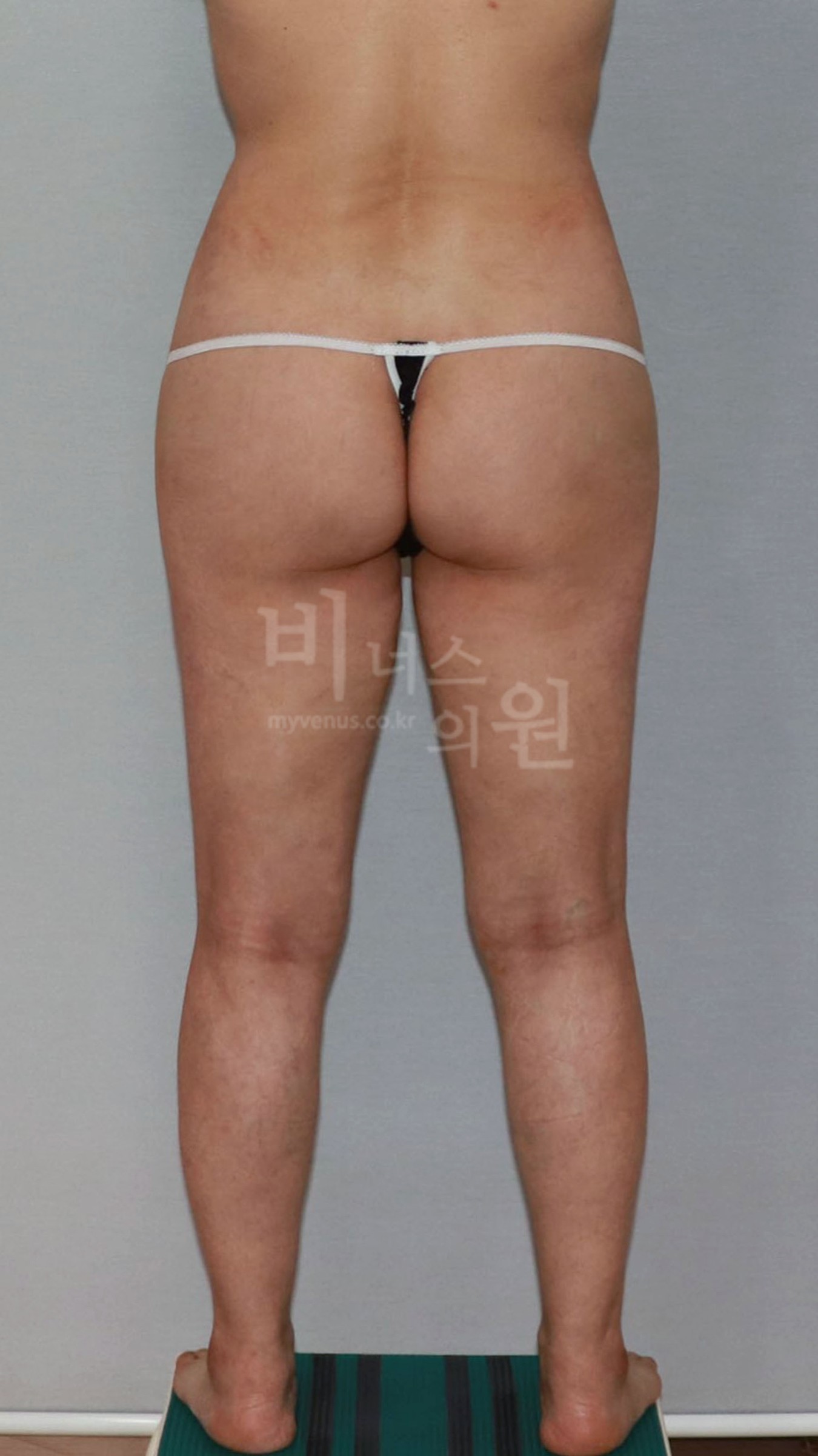 엉덩이축소 지방흡입 후면 참고 사진 2