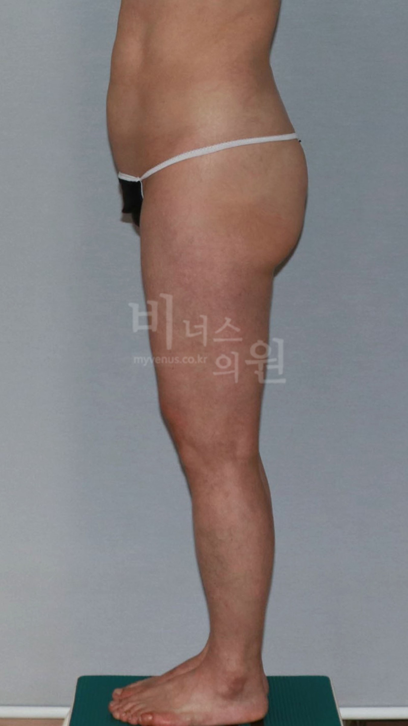 엉덩이축소 지방흡입 측면 참고 사진 1