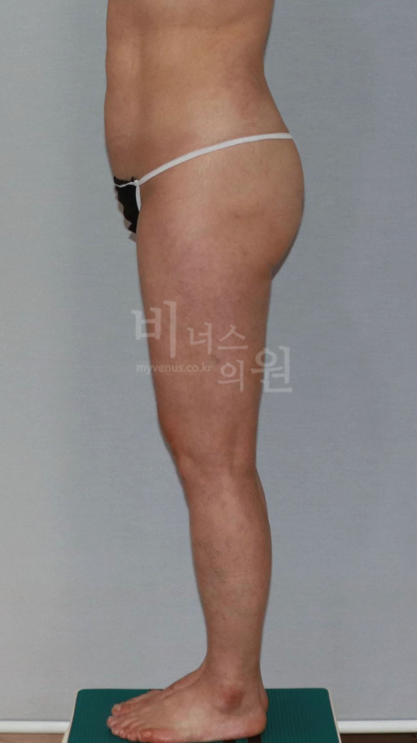 엉덩이축소 지방흡입 측면 참고 사진 2