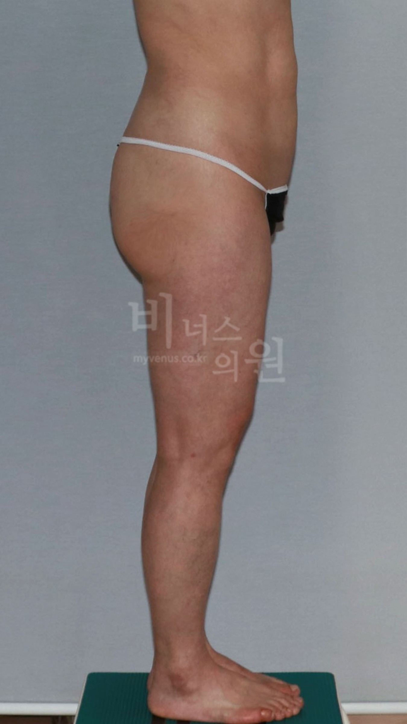 엉덩이축소 지방흡입 측면 참고 사진 3