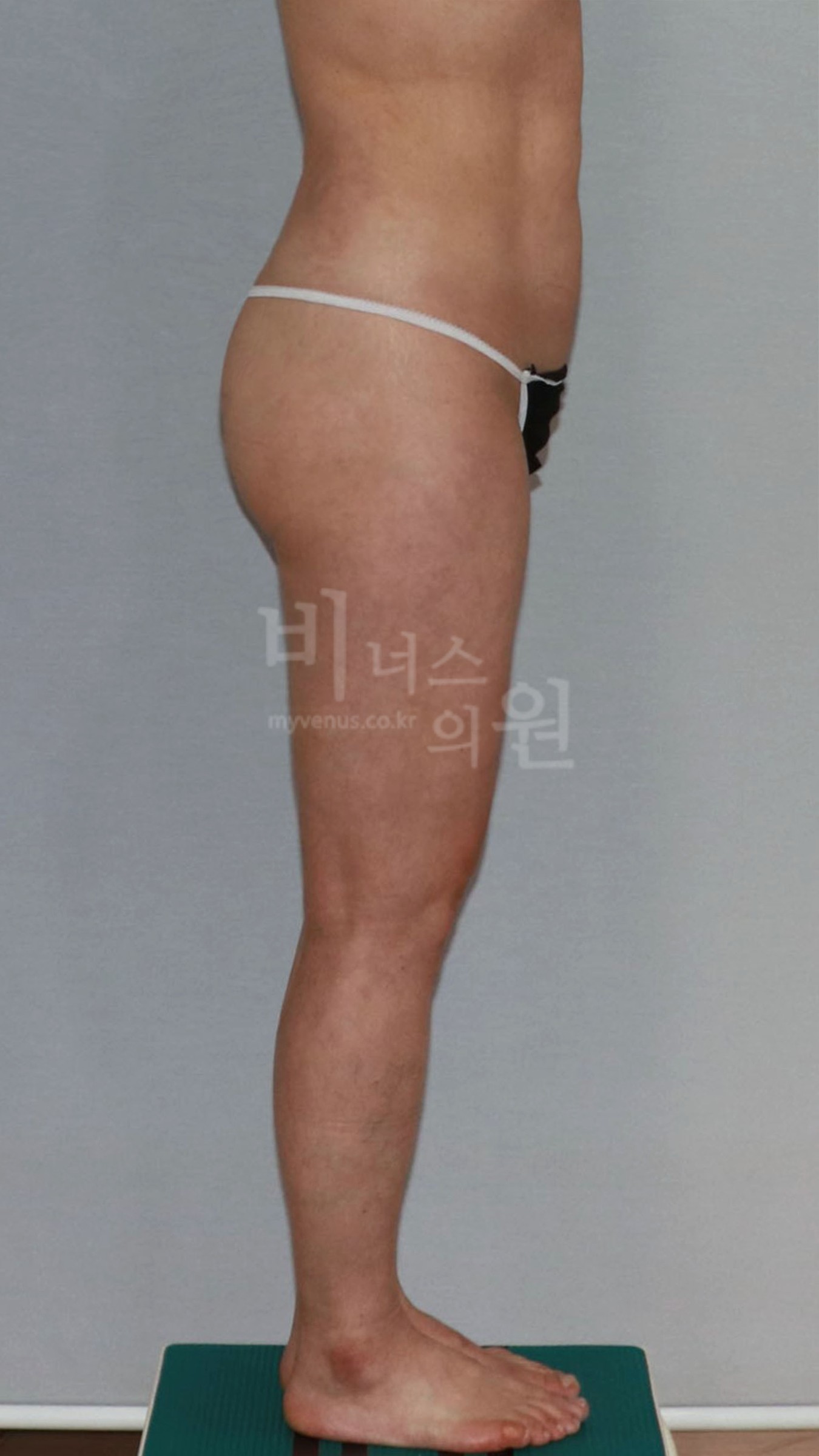 엉덩이축소 지방흡입 측면 참고 사진 4