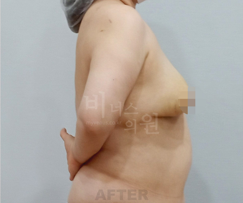 유방처짐 가슴지방흡입 수술 후 측면 사진 - 처짐 개선