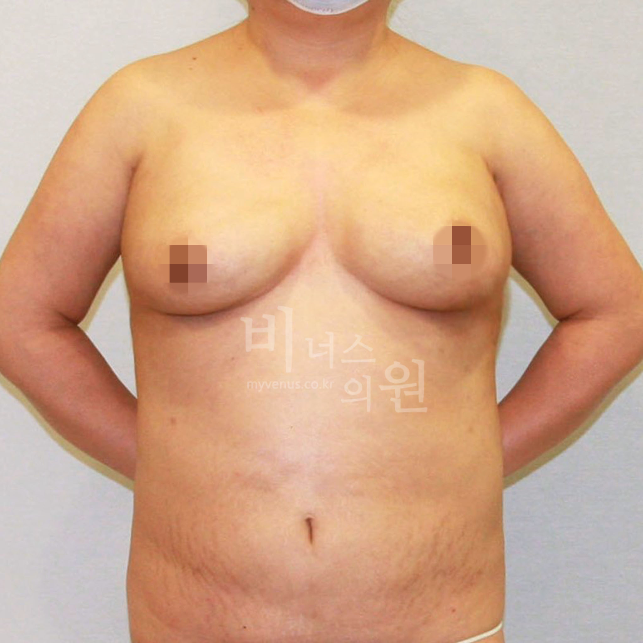 유방처짐 표층지방흡입 수술 후 정면