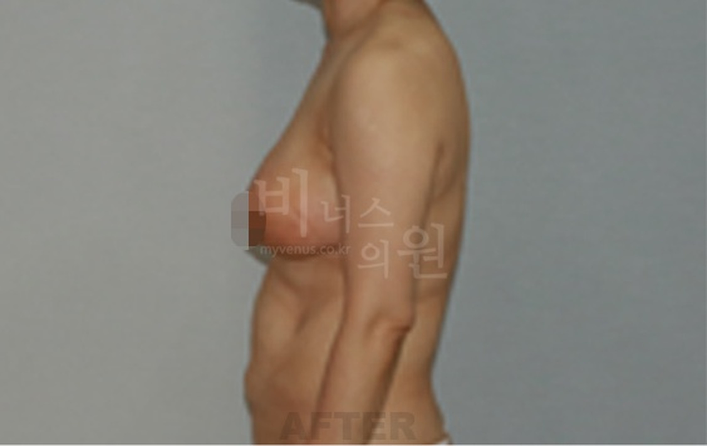 유방 표층 지방흡입 수술 후 우측면 사진