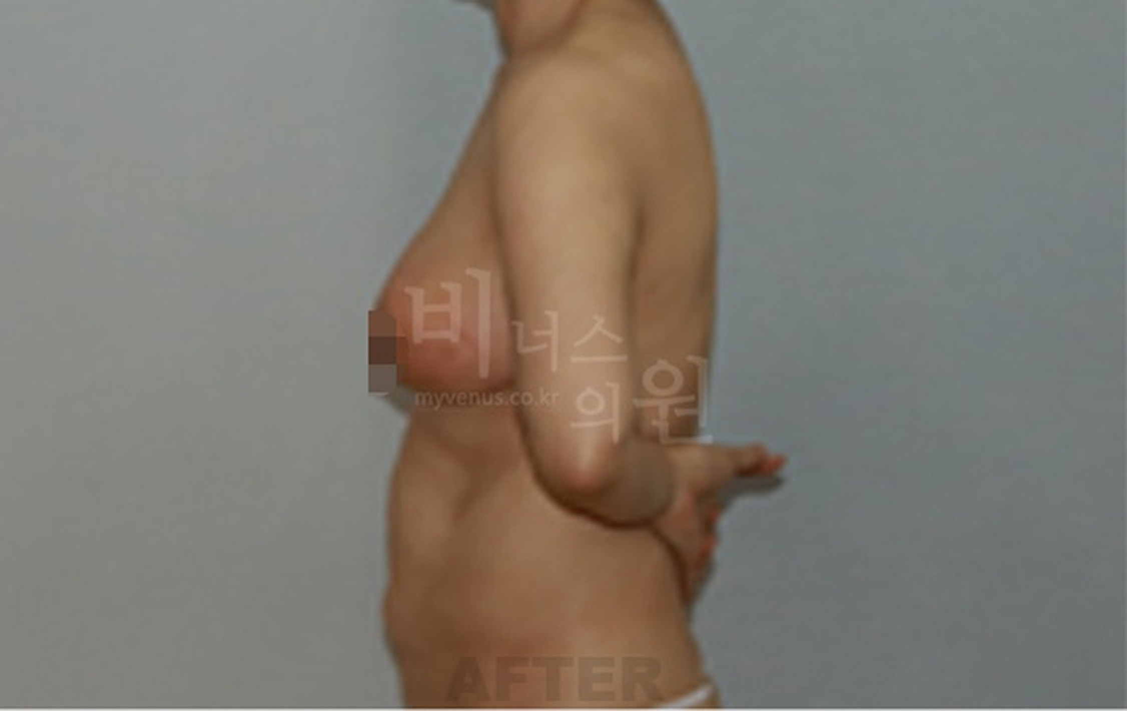 유방 표층 지방흡입 수술 후 우측면(팔을 앞으로) 사진