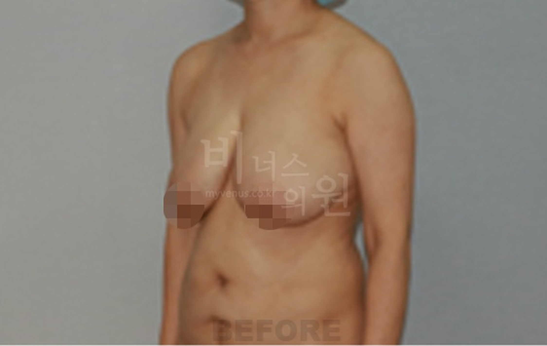 유방 표층 지방흡입 수술 전 우측 45도 측면 사진