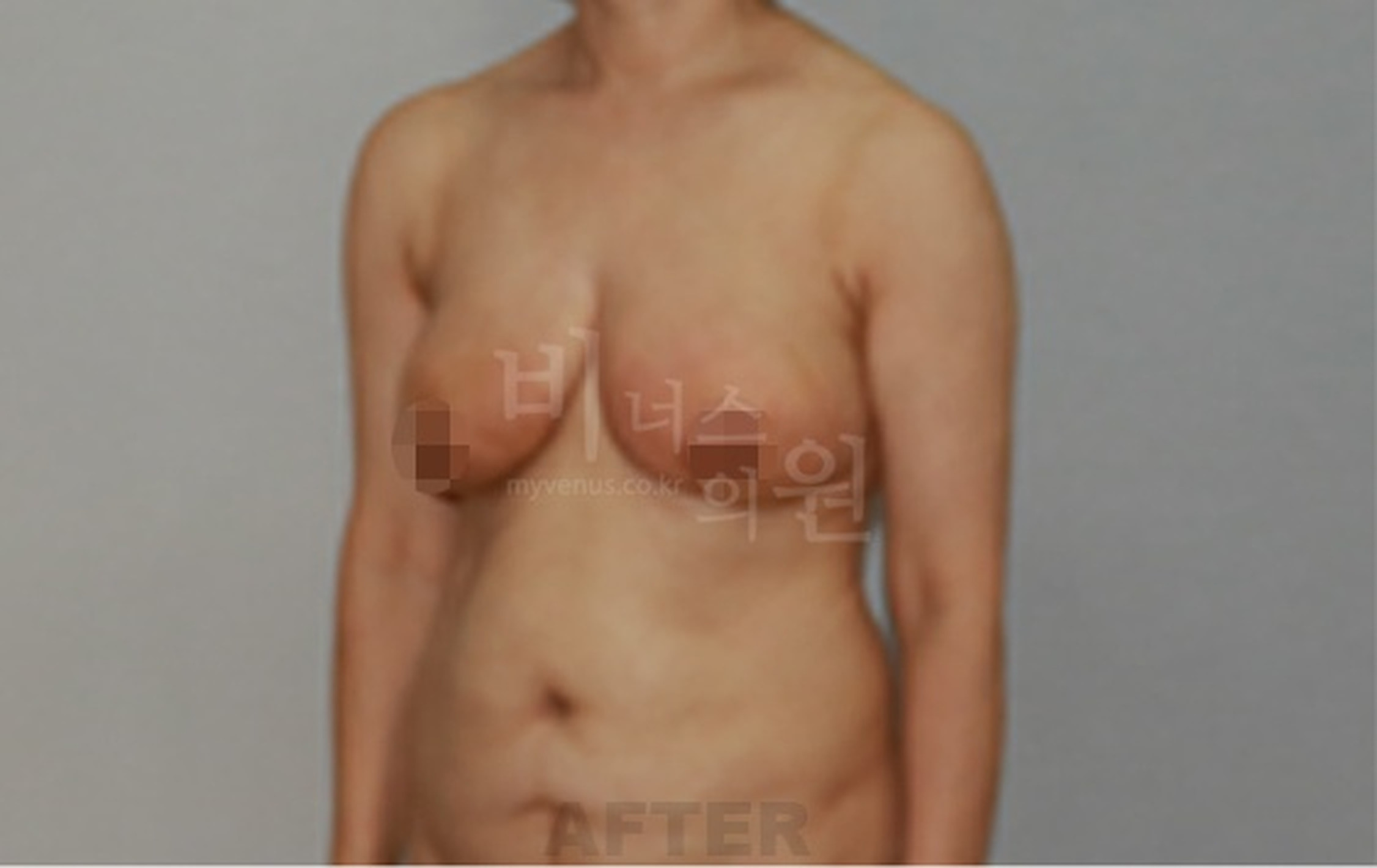 유방 표층 지방흡입 수술 후 우측 45도 측면 사진