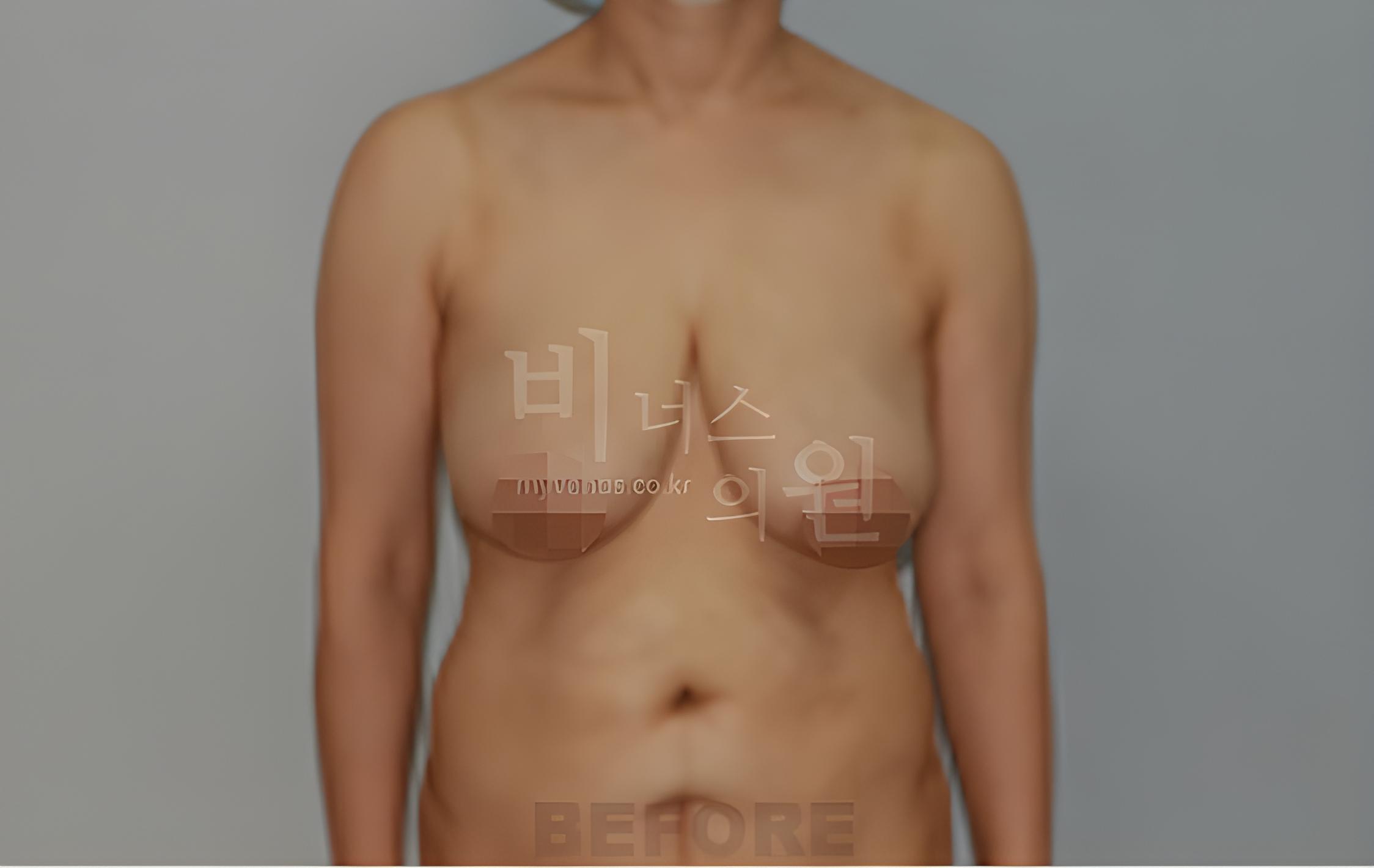 유방 표층 지방흡입 수술 전 정면 사진