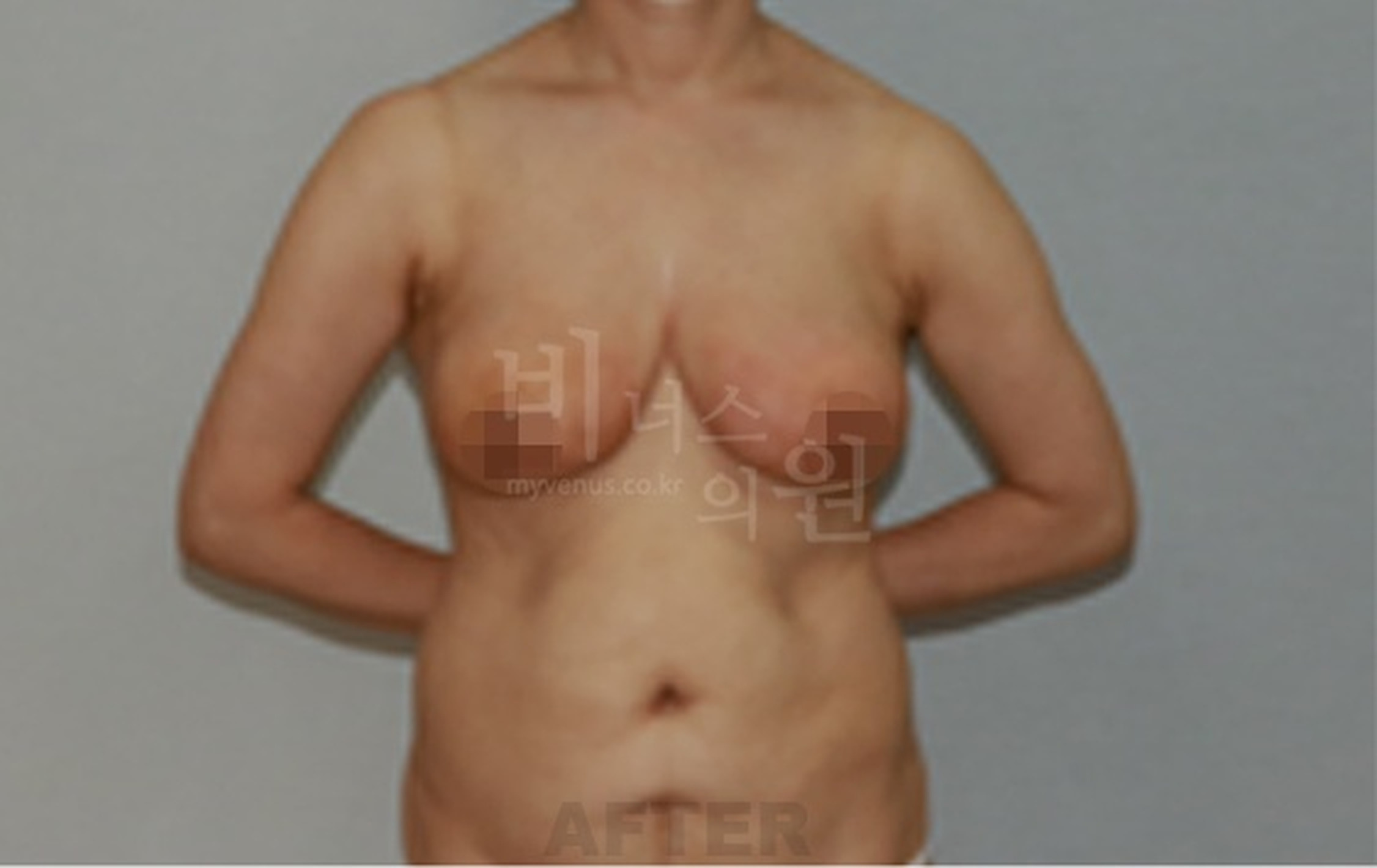 유방 표층 지방흡입 수술 후 정면(팔을 벌린 자세) 사진