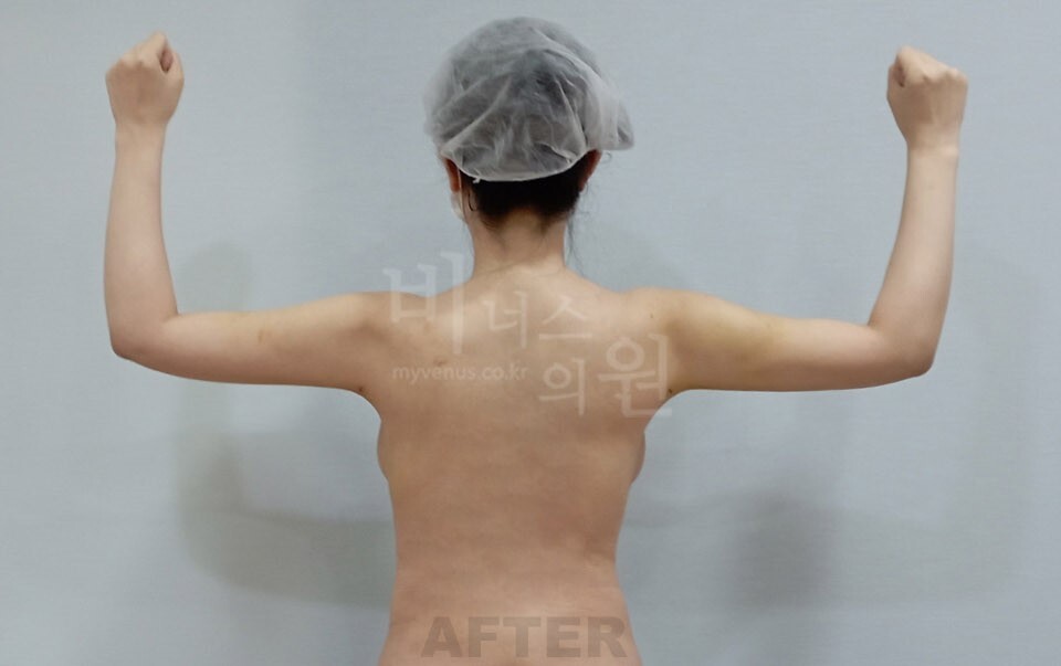 팔뚝지방흡입 수술 후 후면(팔을 들어 올린 자세) 비너스의원