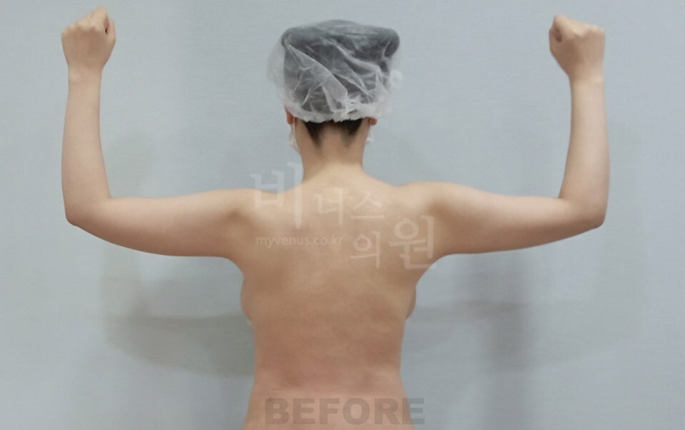 팔뚝지방흡입 수술 전 후면(팔을 들어 올린 자세) 비너스의원