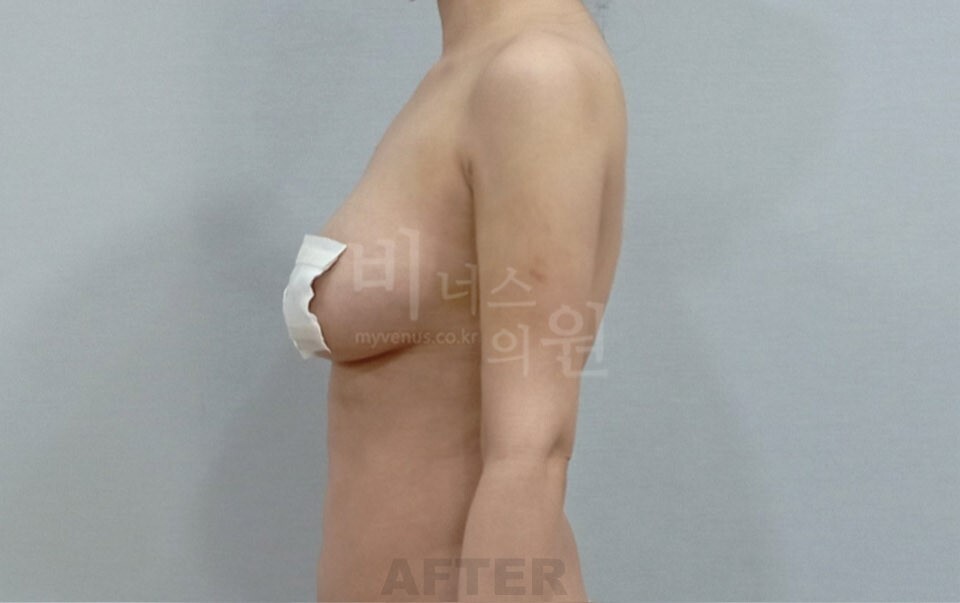 팔뚝지방흡입 수술 후 측면 비너스의원