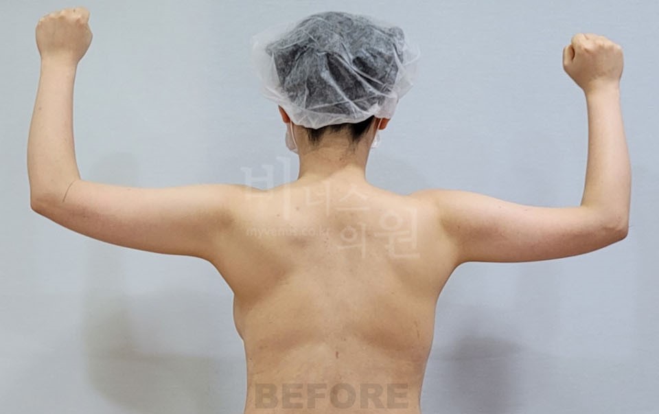 팔뚝지방흡입 수술 전 후면
