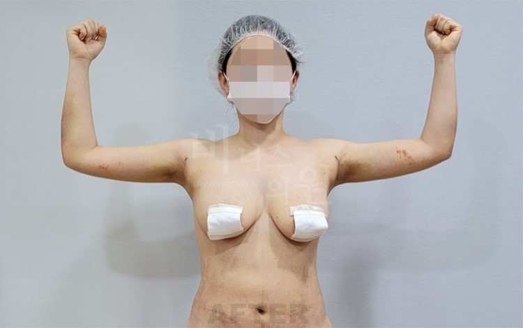 팔뚝지방흡입 수술 후 정면