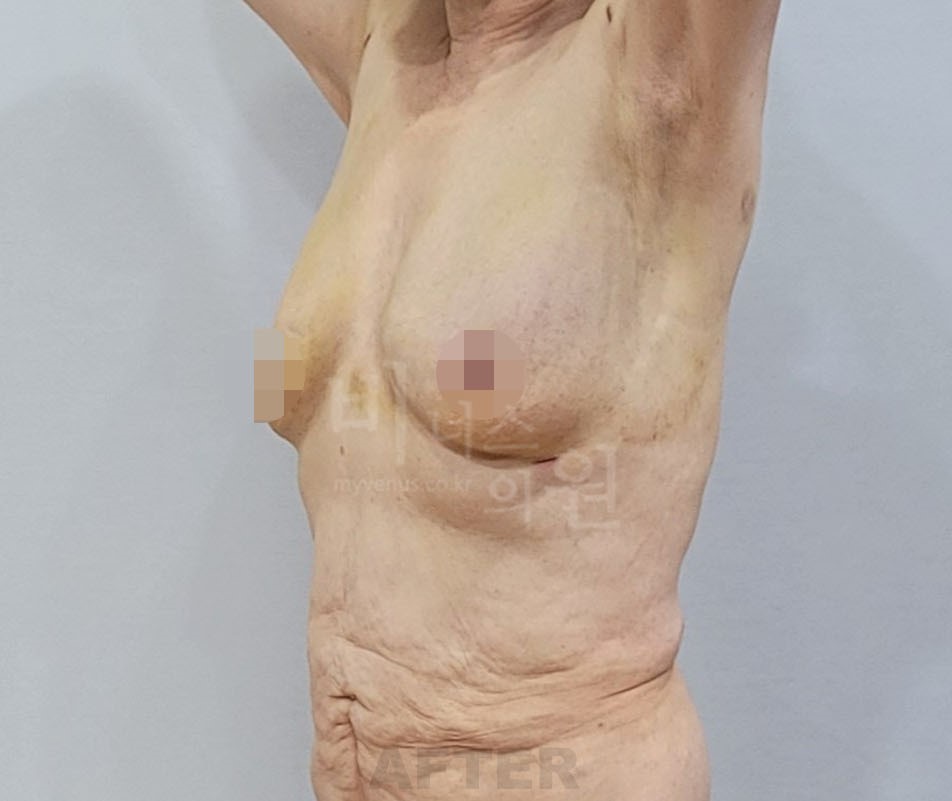유방하수 가슴축소 지방흡입 수술 후 45도 측면