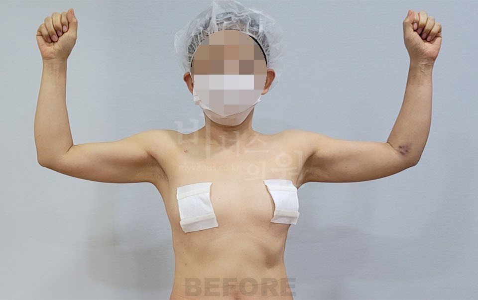 팔뚝 지방흡입 수술 전, 정면 양팔을 벌리고 팔꿈치를 구부린 자세