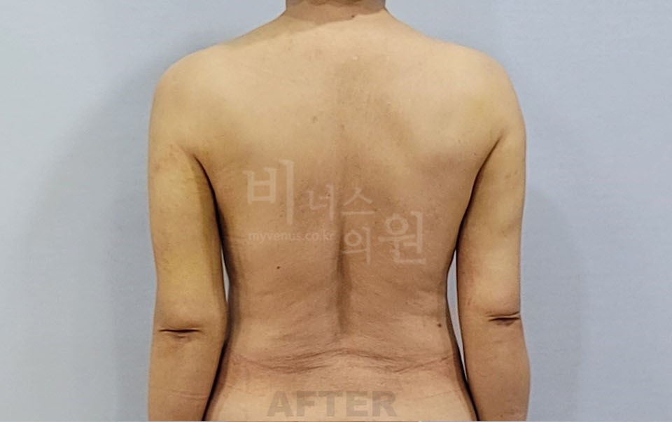 팔뚝 지방흡입 수술 후, 후면 팔을 내린 자세