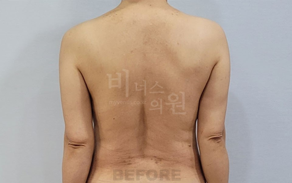 팔뚝 지방흡입 수술 전, 후면 팔을 내린 자세