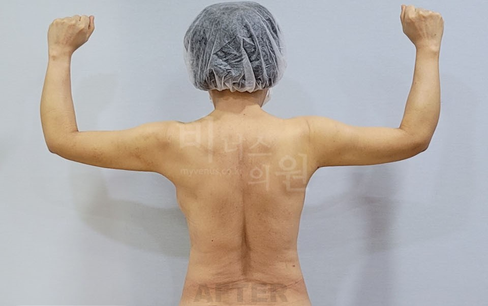 팔뚝 지방흡입 수술 후, 후면 양팔을 벌리고 팔꿈치를 구부린 자세