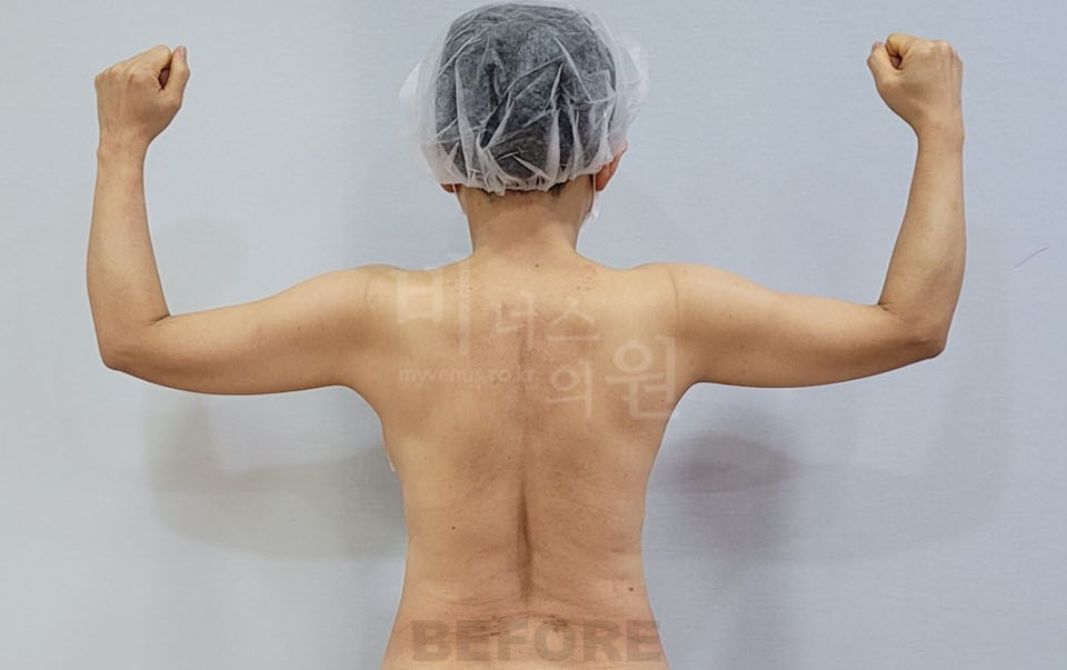 팔뚝 지방흡입 수술 전, 후면 양팔을 벌리고 팔꿈치를 구부린 자세