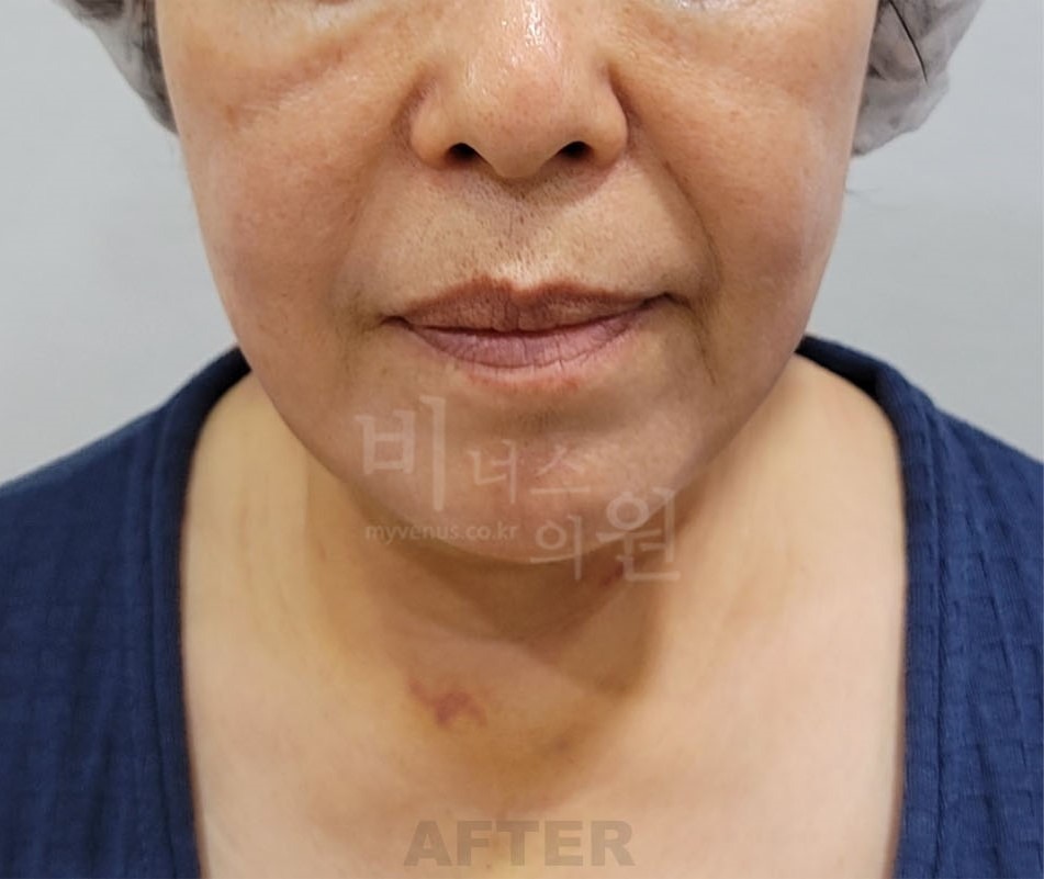 턱지방흡입 수술 후 정면 사진 - 턱선 정리