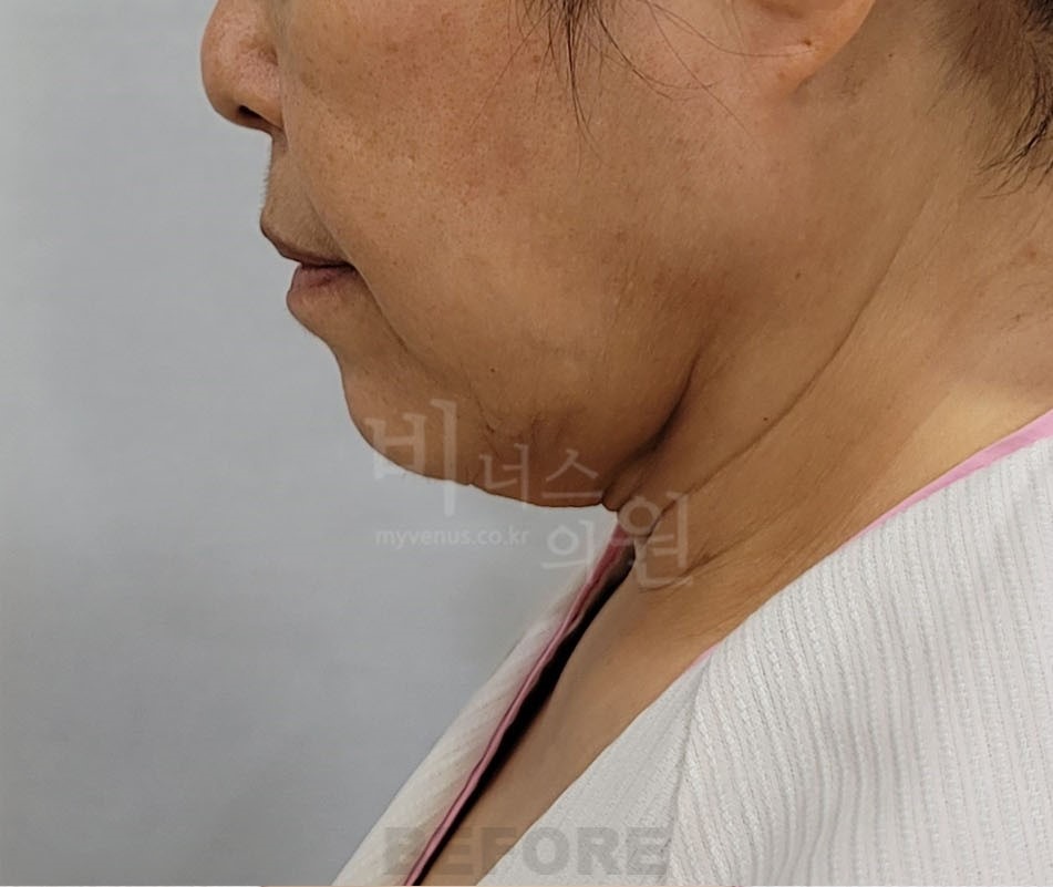 턱지방흡입 수술 전 측면① 사진 - 이중턱, 목 경계 불분명