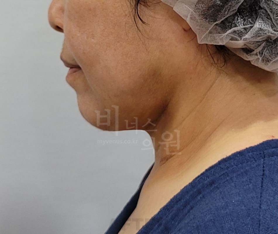턱지방흡입 수술 후 측면① 사진 - 턱과 목 경계 정리