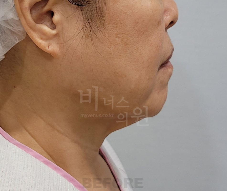 턱지방흡입 수술 전 측면② 사진 - 이중턱, 목 경계 불분명