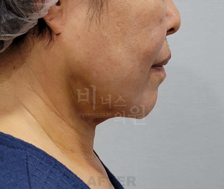 턱지방흡입 수술 후 측면② 사진 - 턱과 목 경계 정리