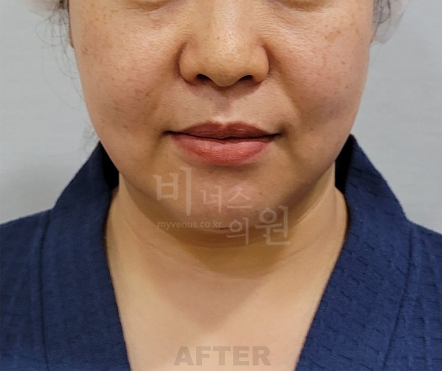 턱지방흡입 수술 후 정면