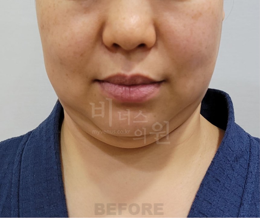 턱지방흡입 수술 전 정면