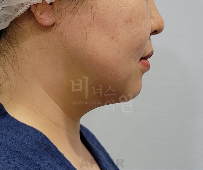 턱지방흡입 수술 후 좌측면