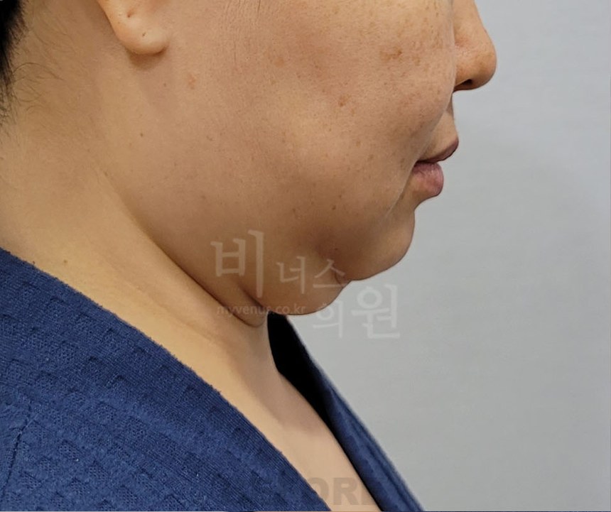 턱지방흡입 수술 전 좌측면