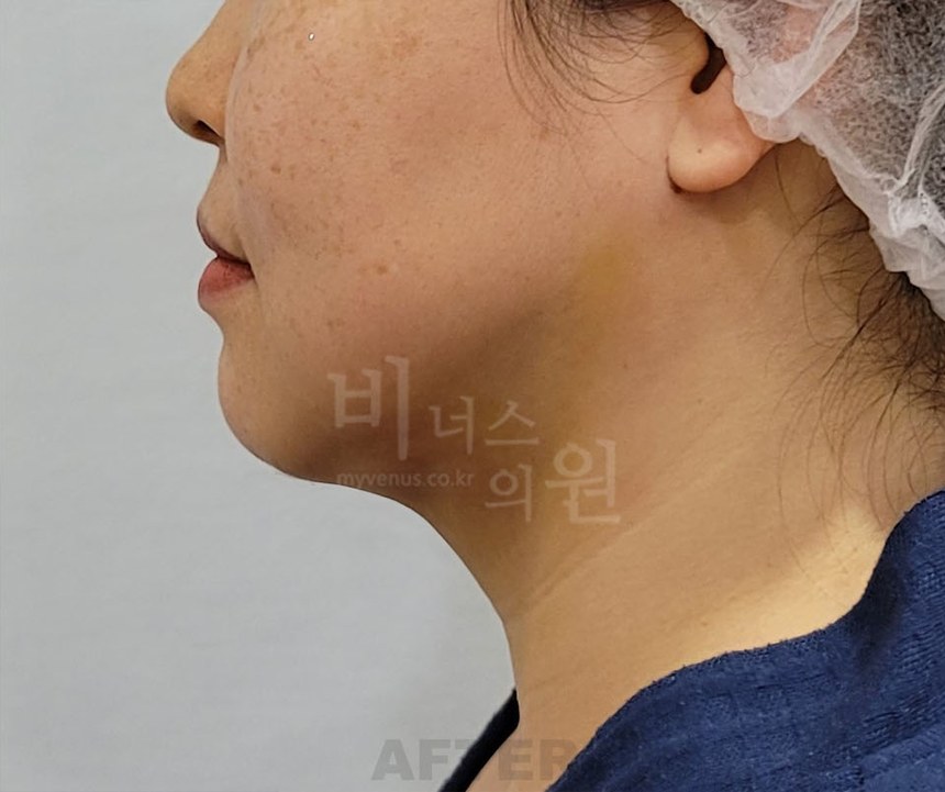 턱지방흡입 수술 후 우측면
