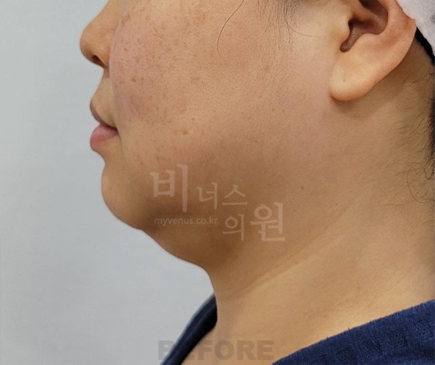 턱지방흡입 수술 전 우측면