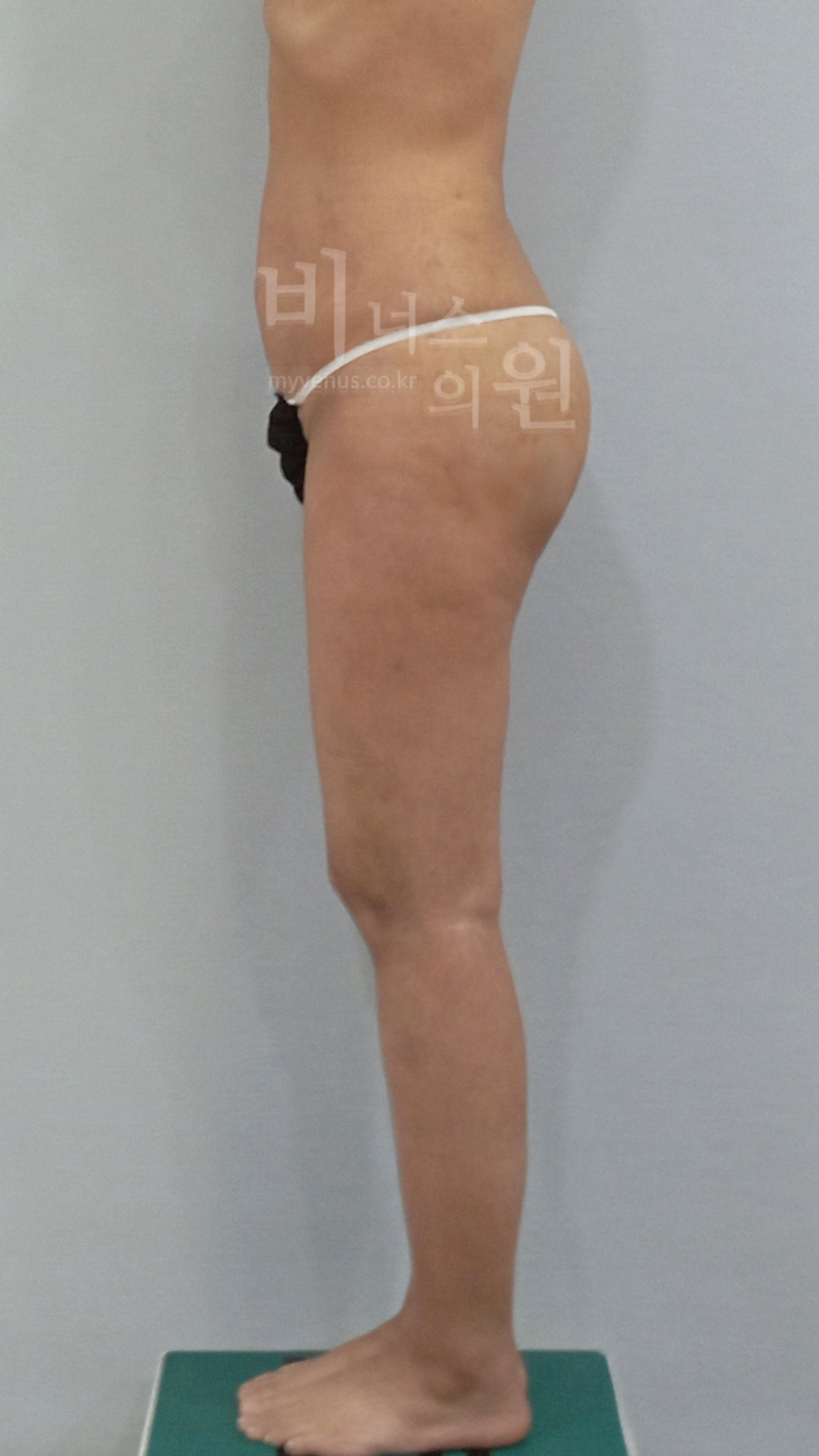 엉덩이 지방흡입 측면 수술 후, 2023년 촬영