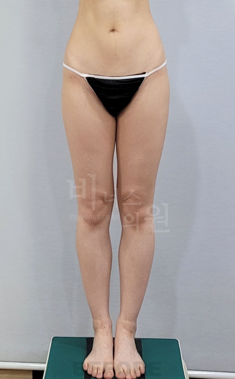 허벅지 지방흡입 수술 전 정면(발모음)