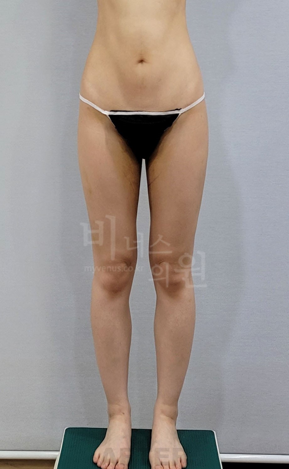 허벅지 지방흡입 수술 후 정면(발벌림)