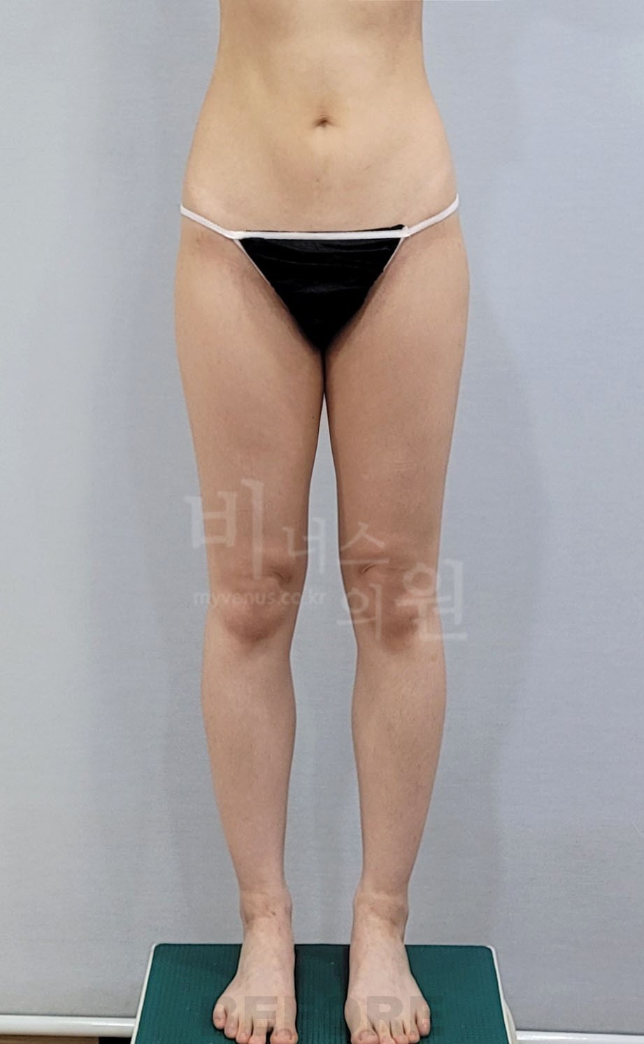 허벅지 지방흡입 수술 전 정면(발벌림)