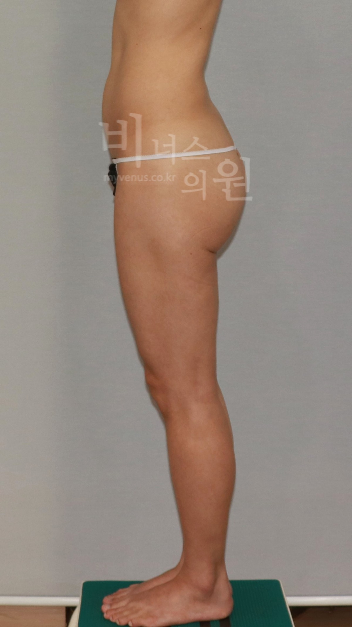 엉덩이축소 지방흡입 수술 전 측면
