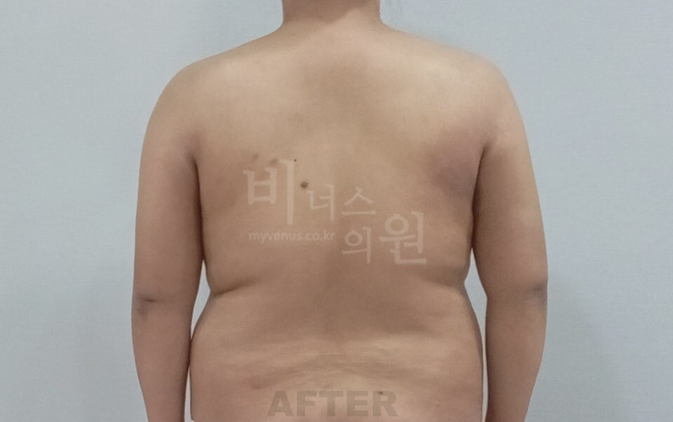 팔뚝지방흡입 수술 후 후면(팔을 내린 자세)