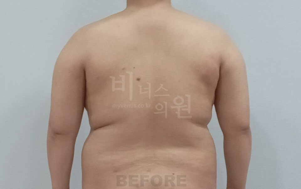 팔뚝지방흡입 수술 전 후면(팔을 내린 자세)
