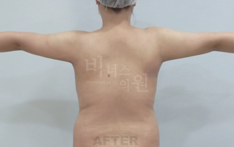 팔뚝지방흡입 수술 후 후면(팔을 벌린 자세)