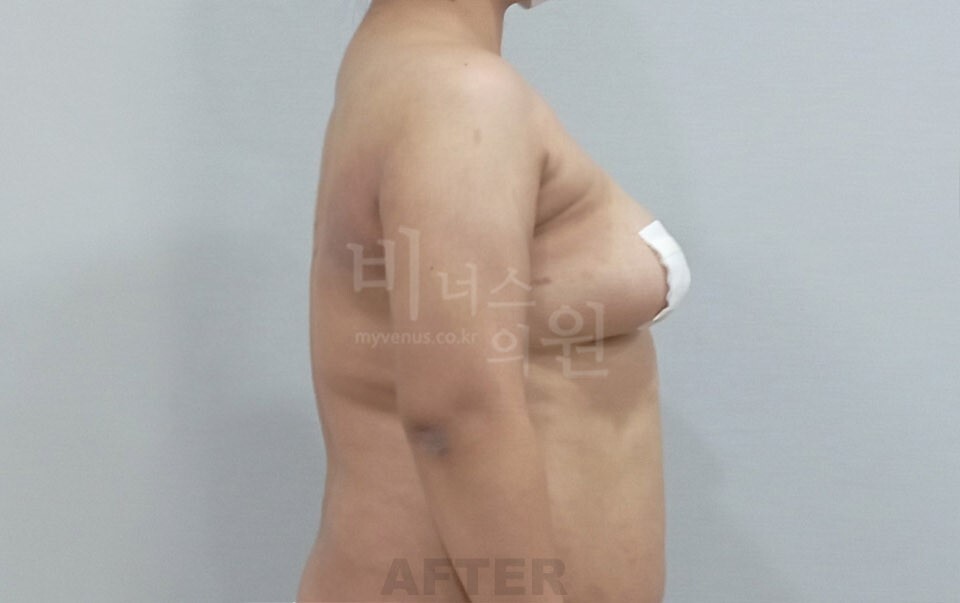 팔뚝지방흡입 수술 후 좌측면