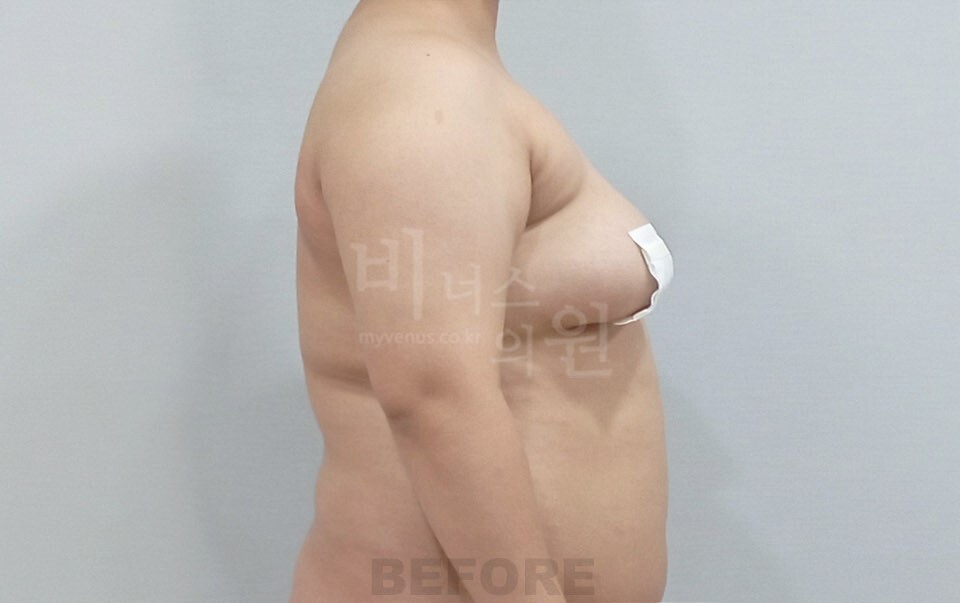 팔뚝지방흡입 수술 전 좌측면