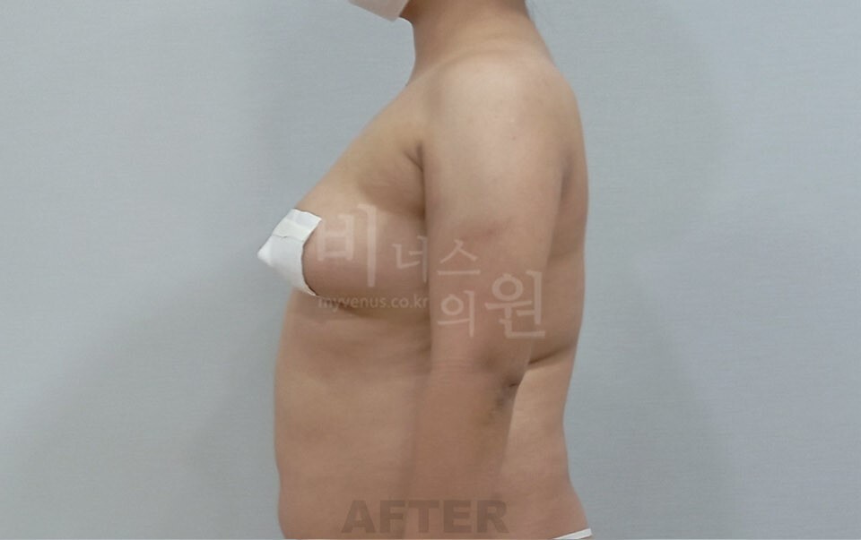 팔뚝지방흡입 수술 후 우측면