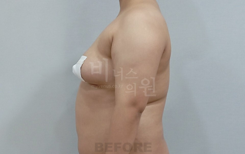 팔뚝지방흡입 수술 전 우측면