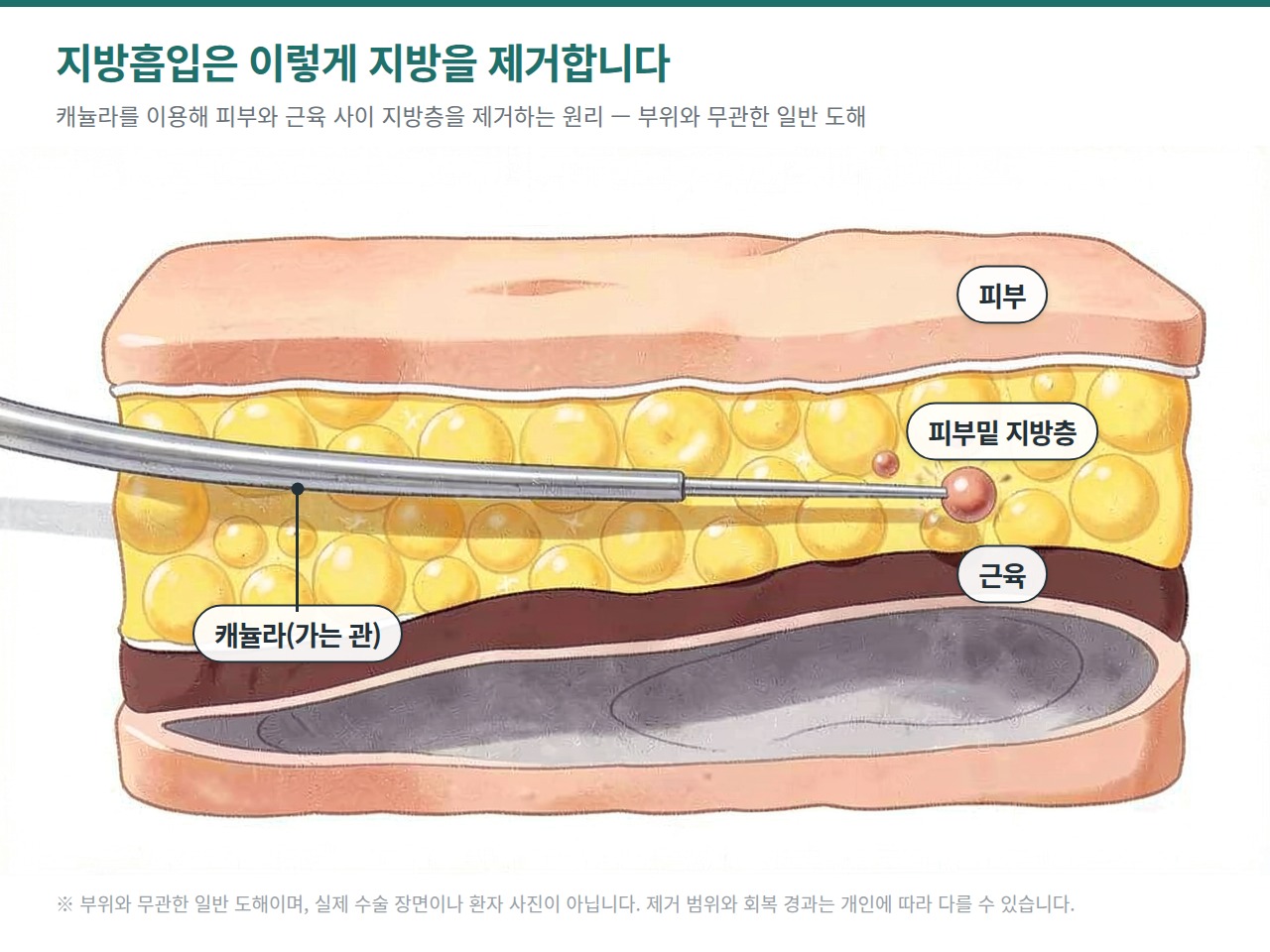 지방흡입 원리 인포그래픽 - 캐뉼라로 피부와 근육 사이 피부밑 지방층을 제거하는 단면 도해